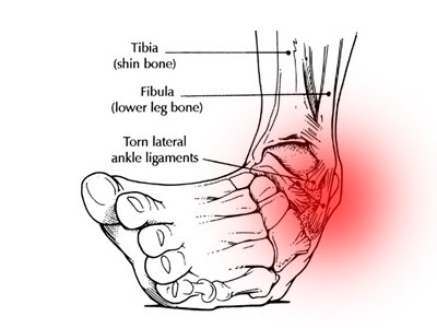 ankle inversion injury